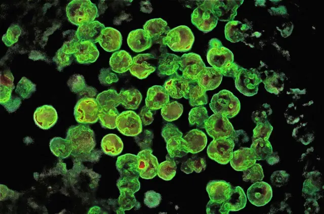 Naegleriasis (or amoebic meningoencephalitis or AMP) is a fatal infection of the brain by the single-celled, free-living eukaryote Naegleria fowleri.