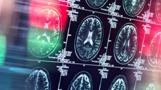 Lecanemab Alzheimer hastalarında bilişsel zayıflamayı yavaşlatıyor